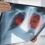 Akciğer Kanseri Geç Belirleniyor: Hastaların Yüzde 60’ı İleri Evrede Tespit Ediliyor