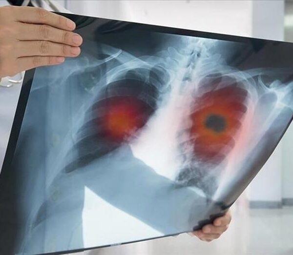 Akciğer Kanseri Geç Belirleniyor: Hastaların Yüzde 60’ı İleri Evrede Tespit Ediliyor