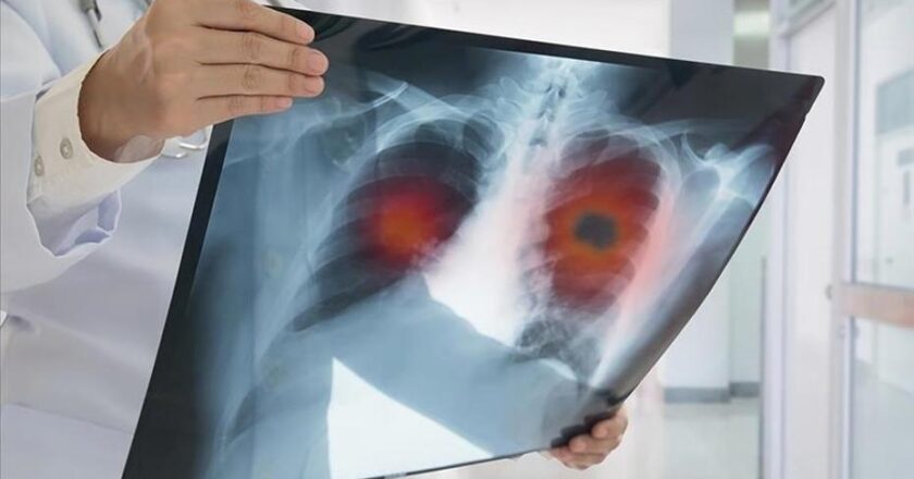 Akciğer Kanseri Geç Belirleniyor: Hastaların Yüzde 60’ı İleri Evrede Tespit Ediliyor